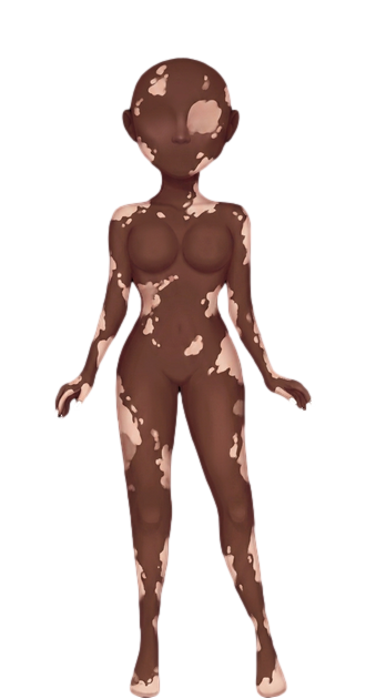 Pele Negra Vitiligo